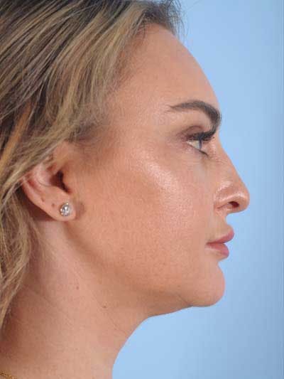 Rhinoplasty Before & After Gallery - Patient 115587 - Image 1