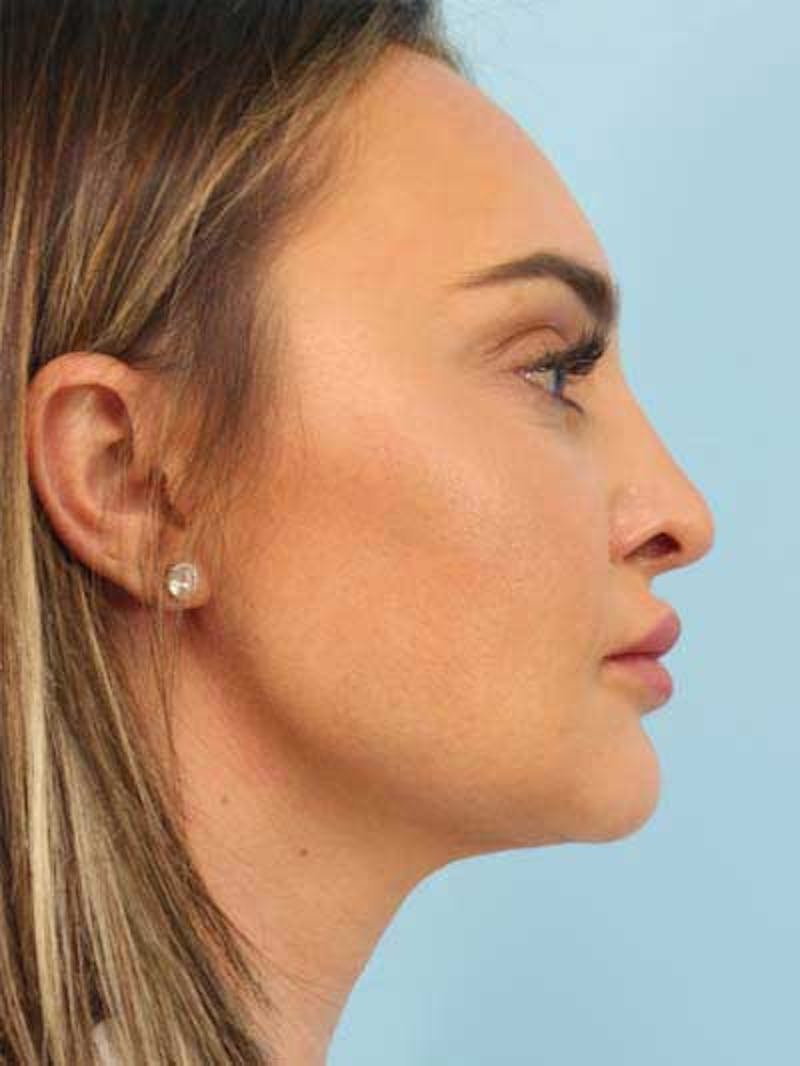 Rhinoplasty Before & After Gallery - Patient 115587 - Image 2