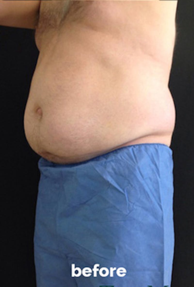 Coolsculpting Before & After Gallery - Patient 184729 - Image 1