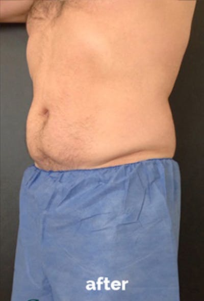 Coolsculpting Before & After Gallery - Patient 184729 - Image 2