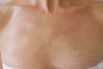 IPL Photofacial Before & After Gallery - Patient 411227 - Image 2