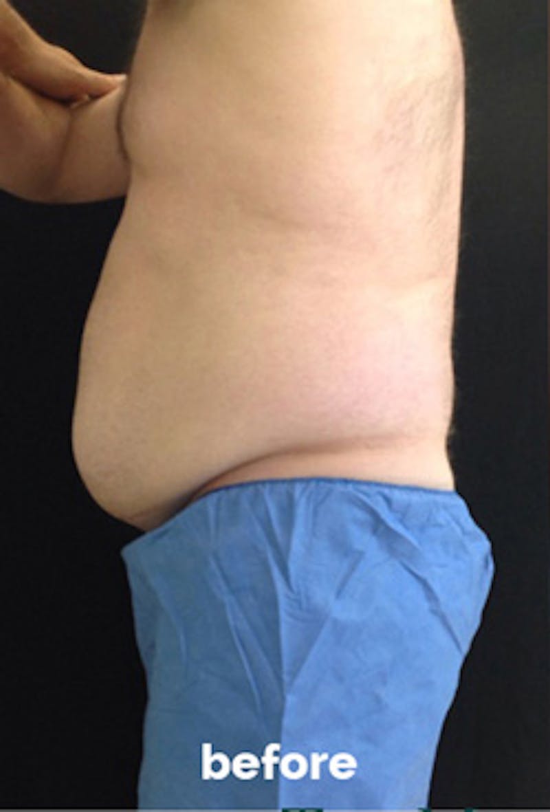 Coolsculpting Before & After Gallery - Patient 184729 - Image 3