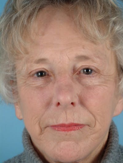 Facelift Before & After Gallery - Patient 251233 - Image 1