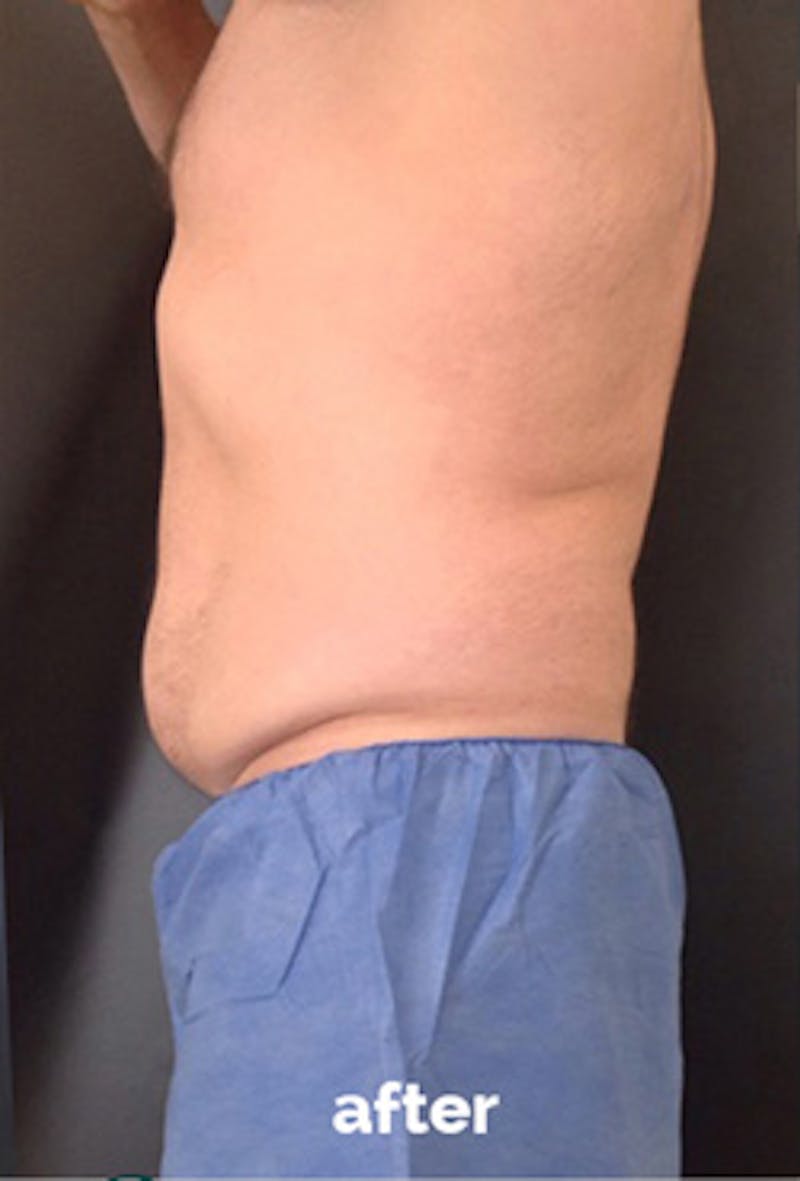Coolsculpting Before & After Gallery - Patient 184729 - Image 4