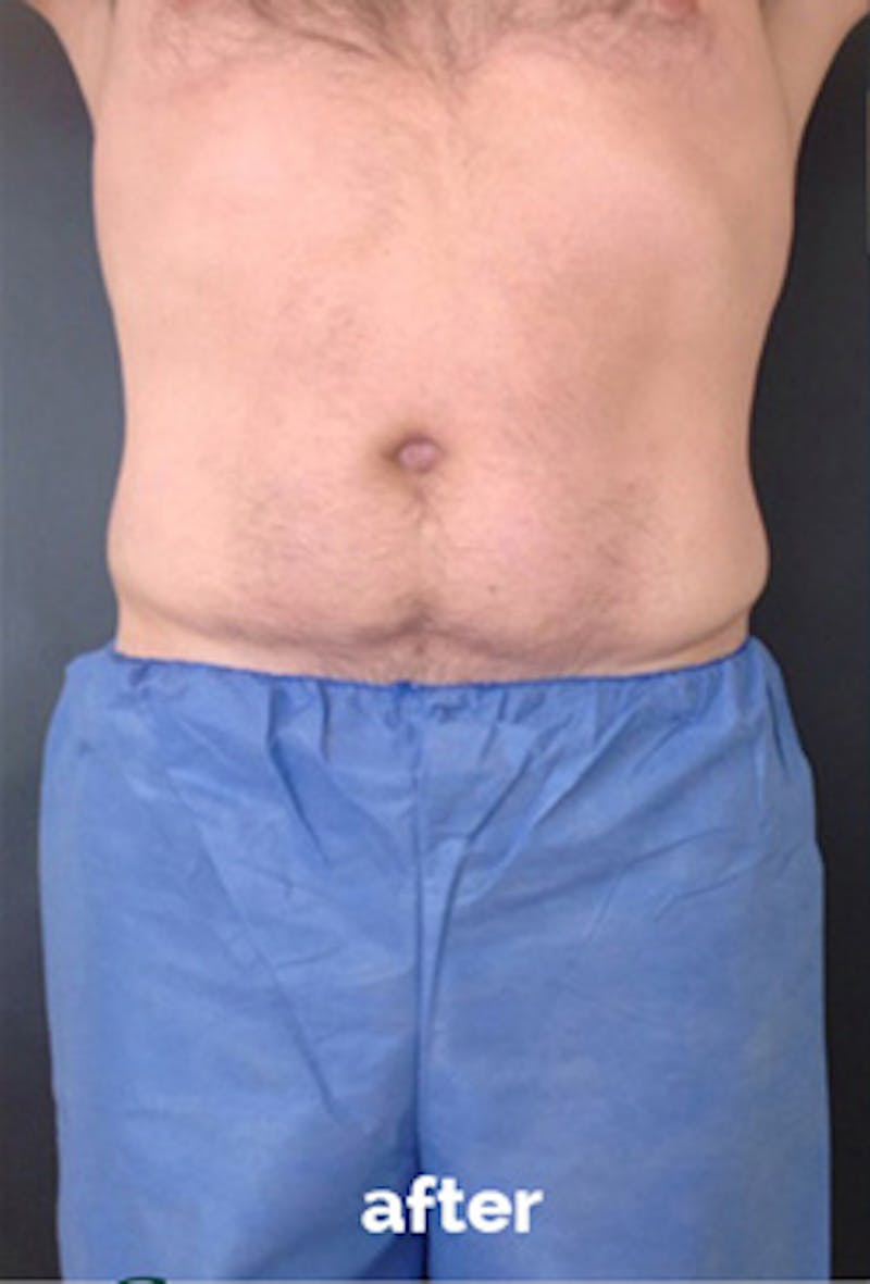 Coolsculpting Before & After Gallery - Patient 184729 - Image 6