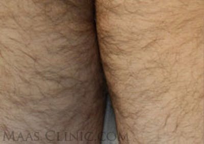 Laser Hair Removal Before & After Gallery - Patient 254946 - Image 1