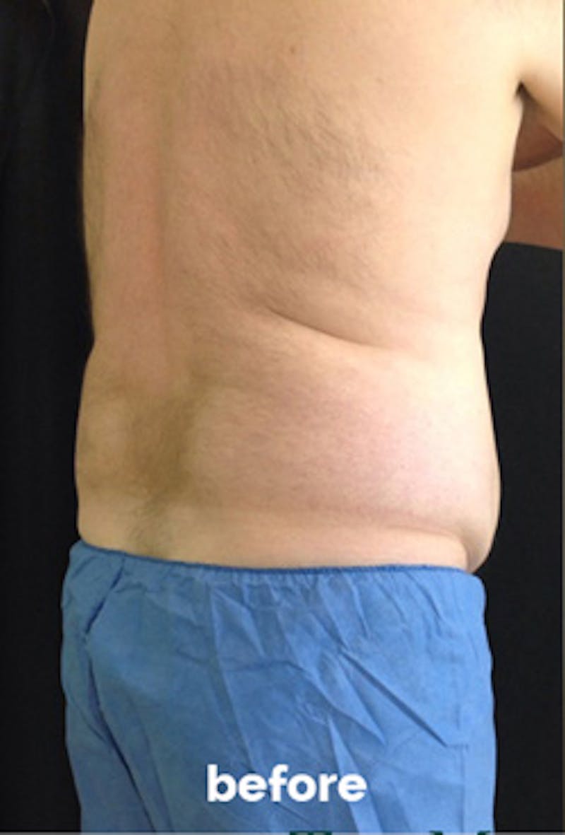 Coolsculpting Before & After Gallery - Patient 184729 - Image 7
