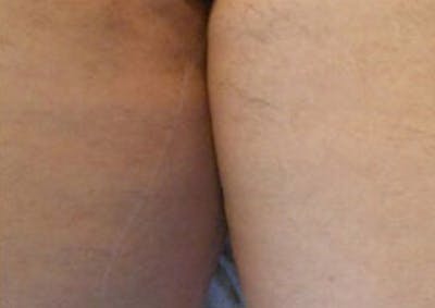 Laser Hair Removal Before & After Gallery - Patient 254946 - Image 2