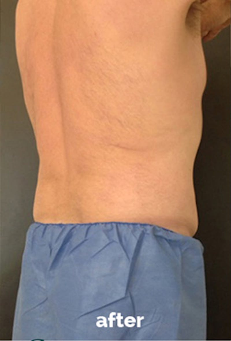 Coolsculpting Before & After Gallery - Patient 184729 - Image 8