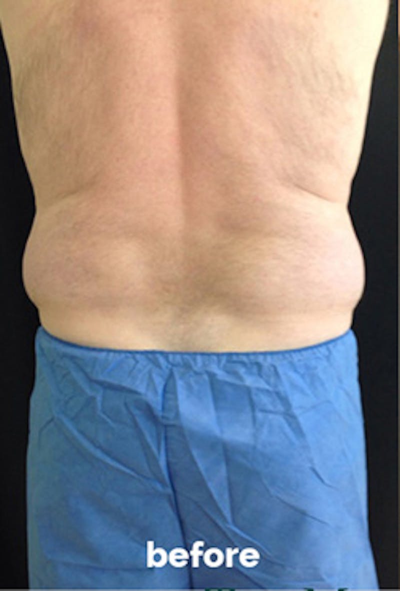 Coolsculpting Before & After Gallery - Patient 184729 - Image 9