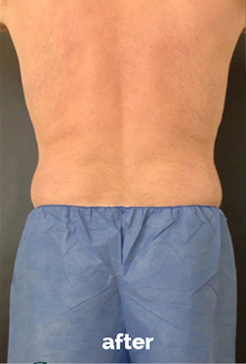 Coolsculpting Before & After Gallery - Patient 184729 - Image 10