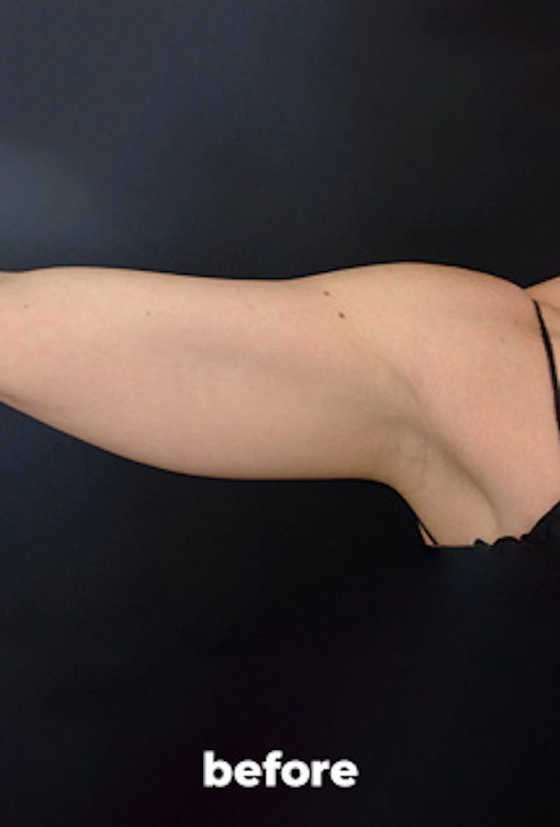 Coolsculpting Before & After Gallery - Patient 336387 - Image 1