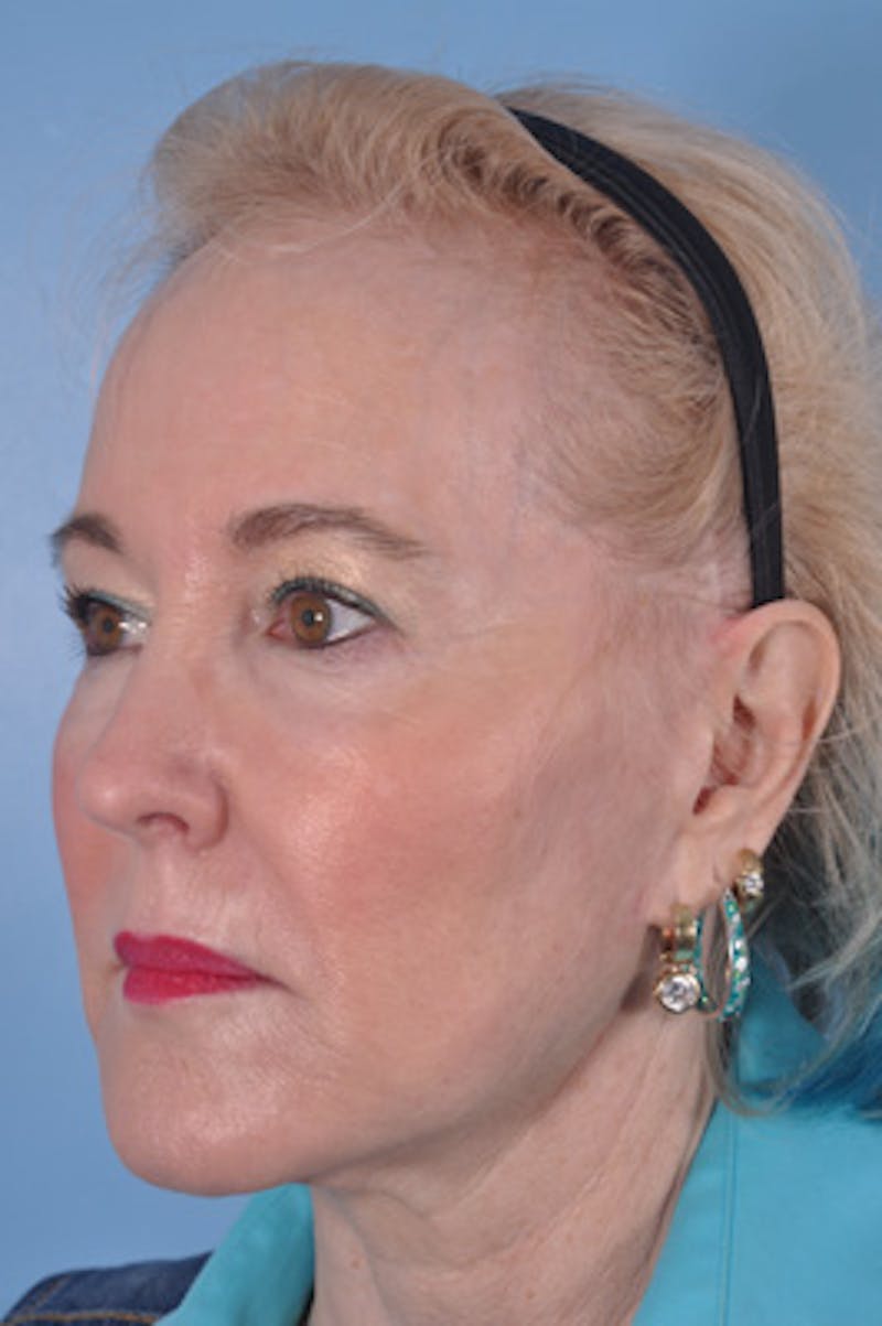 Facial Resurfacing Before & After Gallery - Patient 107436 - Image 3