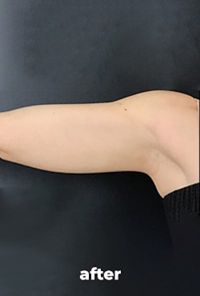Coolsculpting Before & After Gallery - Patient 336387 - Image 2