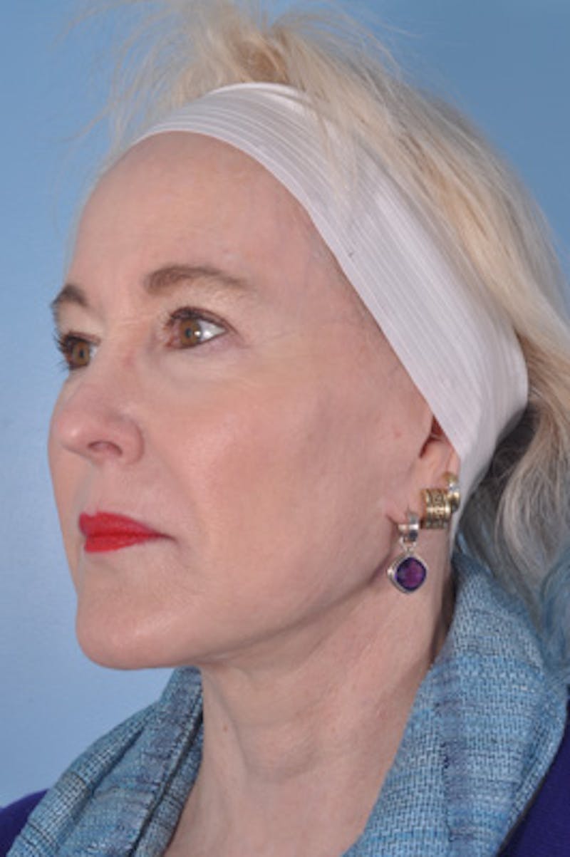Facial Resurfacing Before & After Gallery - Patient 107436 - Image 4