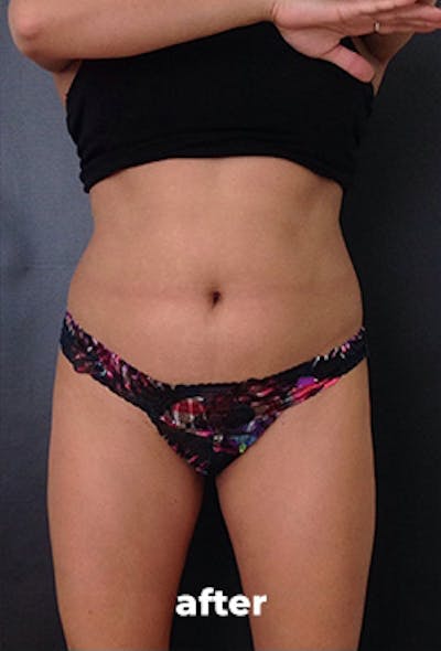 Coolsculpting Before & After Gallery - Patient 151407 - Image 2