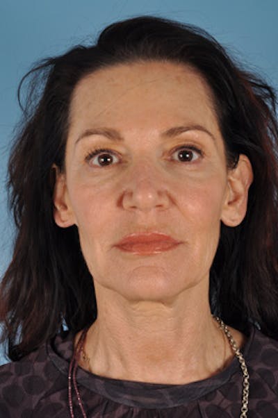 Facelift Before & After Gallery - Patient 133812 - Image 1
