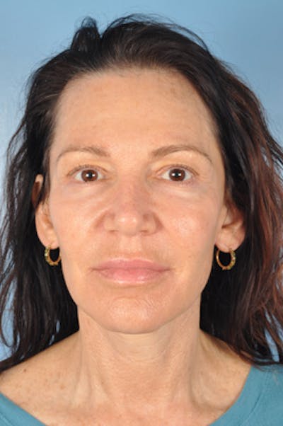 Facelift Before & After Gallery - Patient 133812 - Image 2