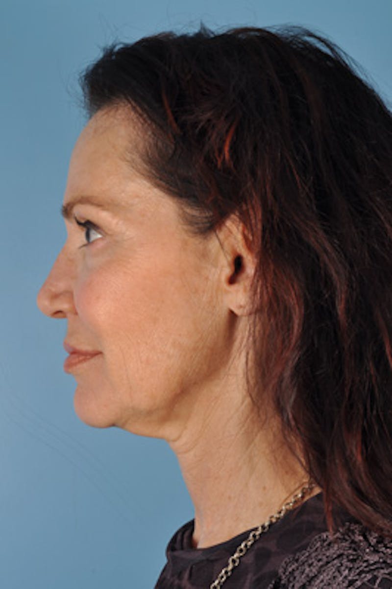 Facelift Before & After Gallery - Patient 133812 - Image 3