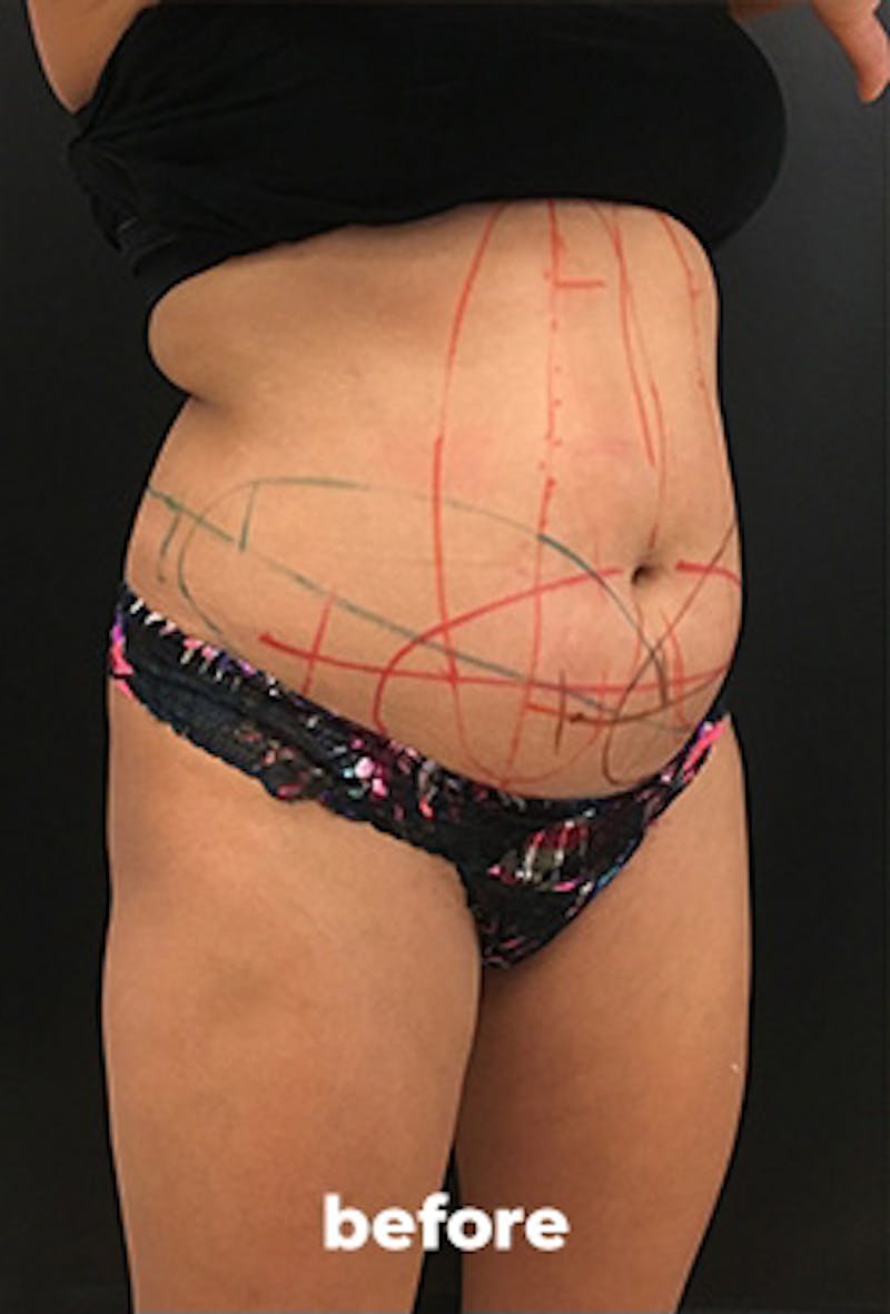 Coolsculpting Before & After Gallery - Patient 151407 - Image 5
