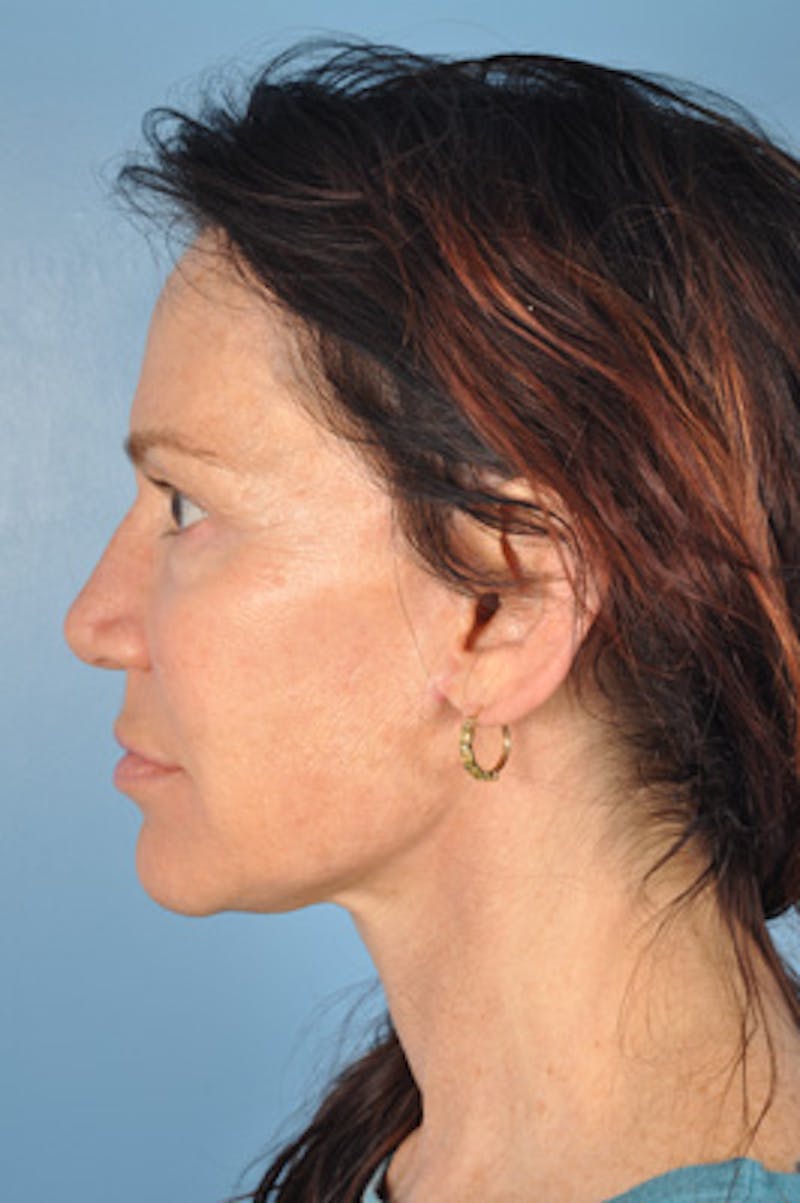 Facelift Before & After Gallery - Patient 133812 - Image 4