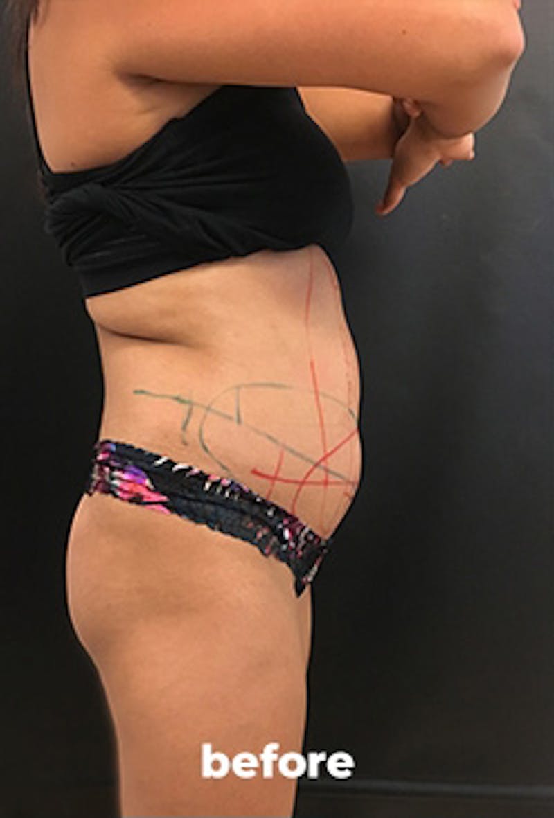 Coolsculpting Before & After Gallery - Patient 151407 - Image 7