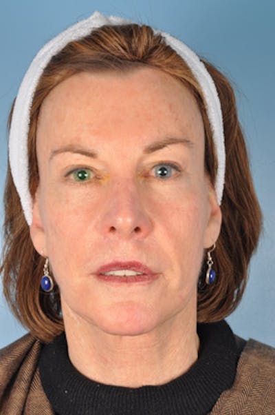 Facelift Before & After Gallery - Patient 274159 - Image 1