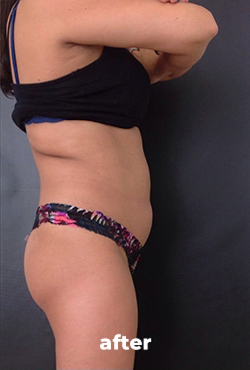 Coolsculpting Before & After Gallery - Patient 151407 - Image 8