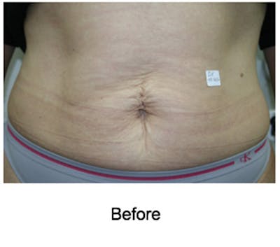 VelaShape Before & After Gallery - Patient 215613 - Image 1