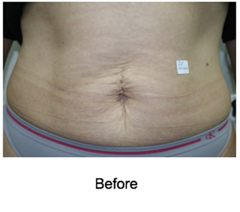 VelaShape Before & After Gallery - Patient 215613 - Image 1