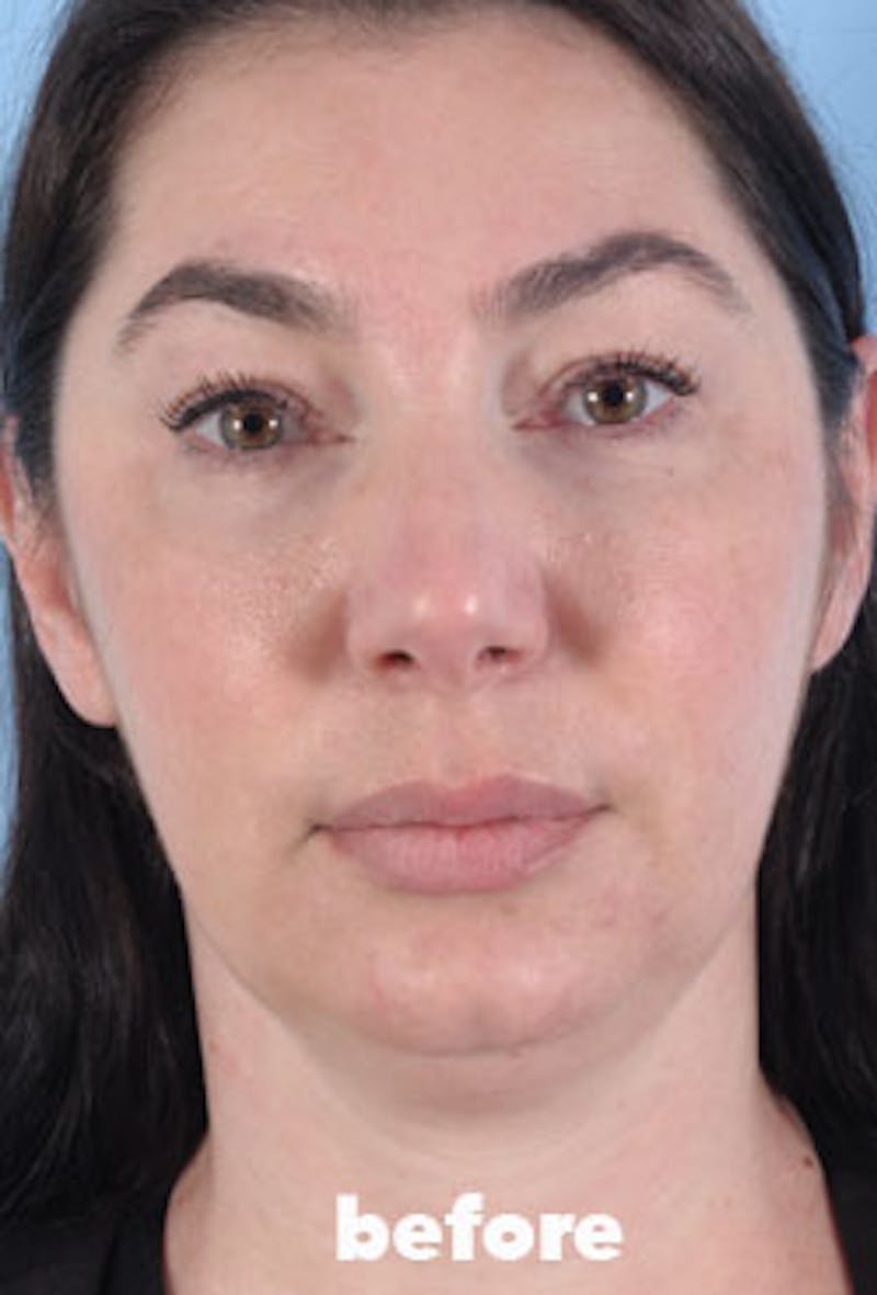 Coolsculpting Before & After Gallery - Patient 208005 - Image 3