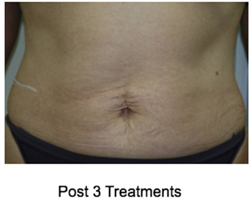 VelaShape Before & After Gallery - Patient 215613 - Image 2