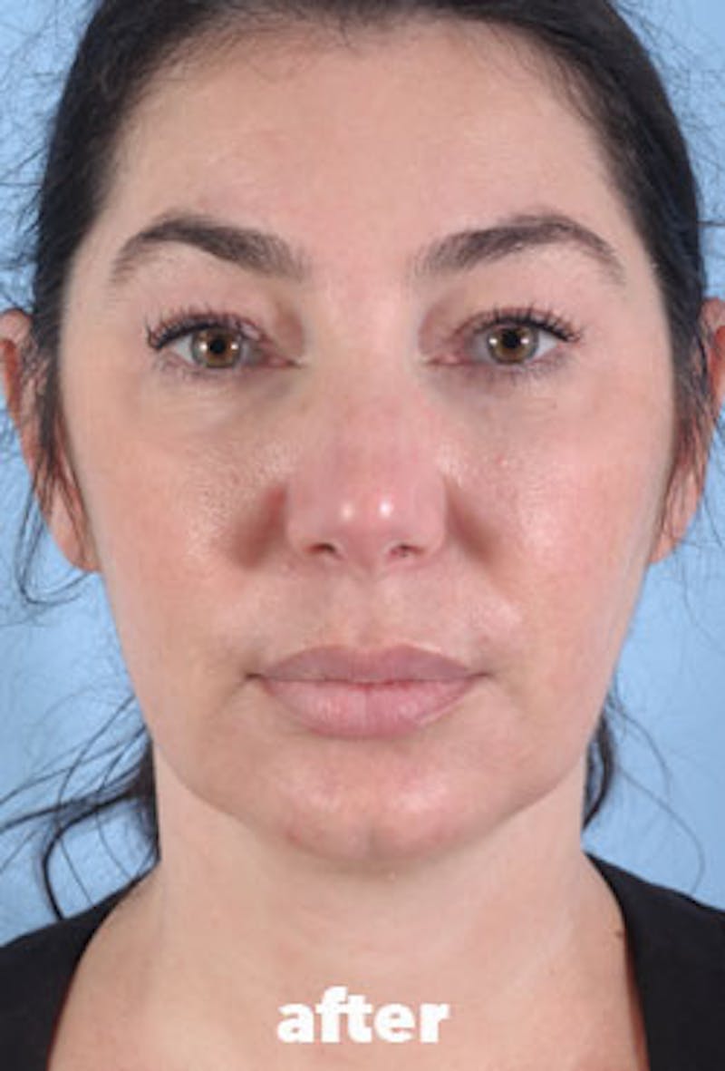 Coolsculpting Before & After Gallery - Patient 208005 - Image 4