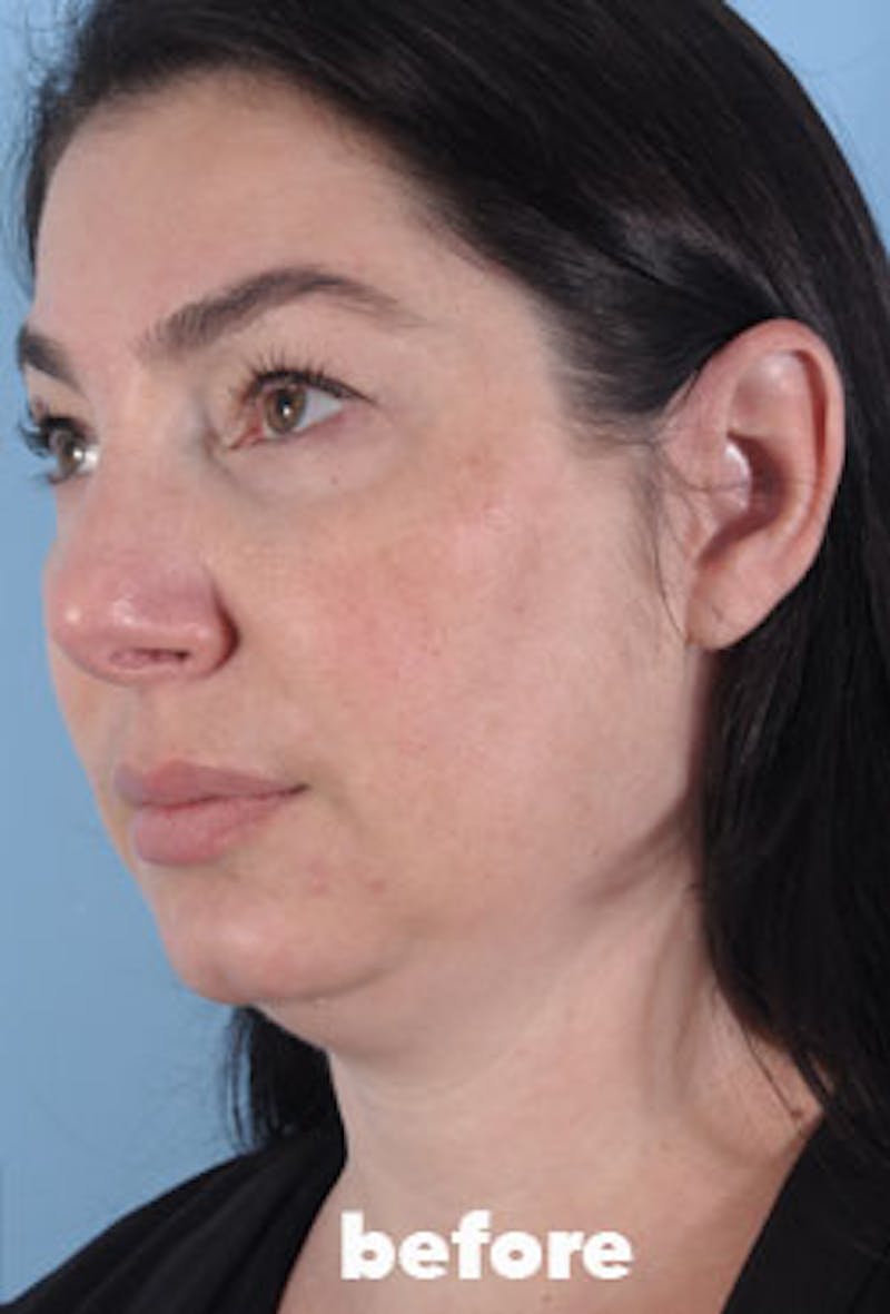 Coolsculpting Before & After Gallery - Patient 208005 - Image 5
