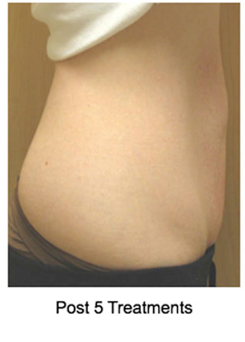 VelaShape Before & After Gallery - Patient 215613 - Image 4