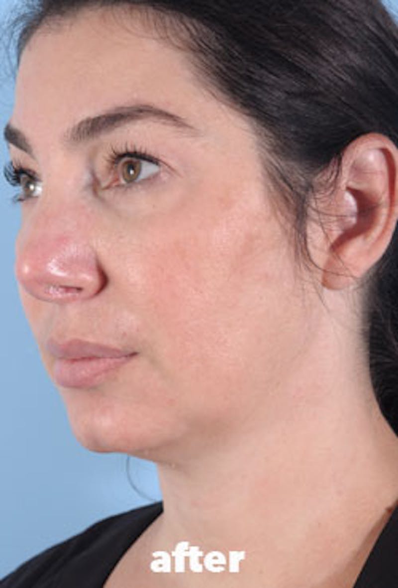 Coolsculpting Before & After Gallery - Patient 208005 - Image 6