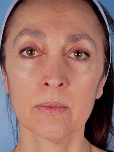 Facelift Before & After Gallery - Patient 105874 - Image 1