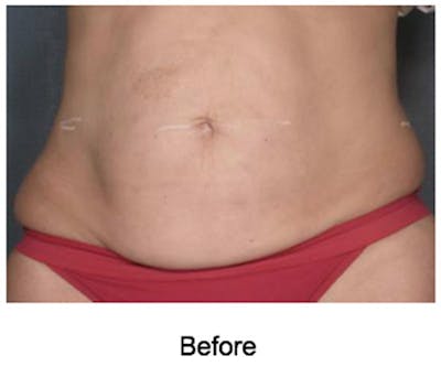 VelaShape Before & After Gallery - Patient 358259 - Image 1