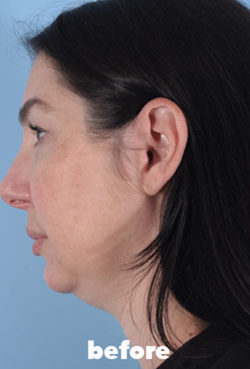 Coolsculpting Before & After Gallery - Patient 208005 - Image 7