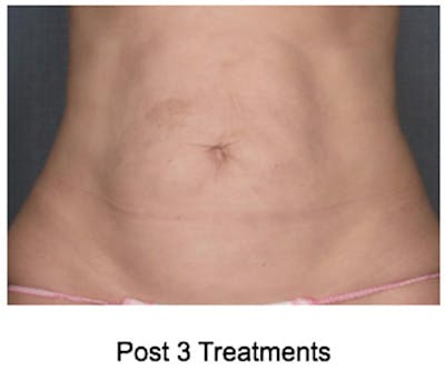 VelaShape Before & After Gallery - Patient 358259 - Image 2