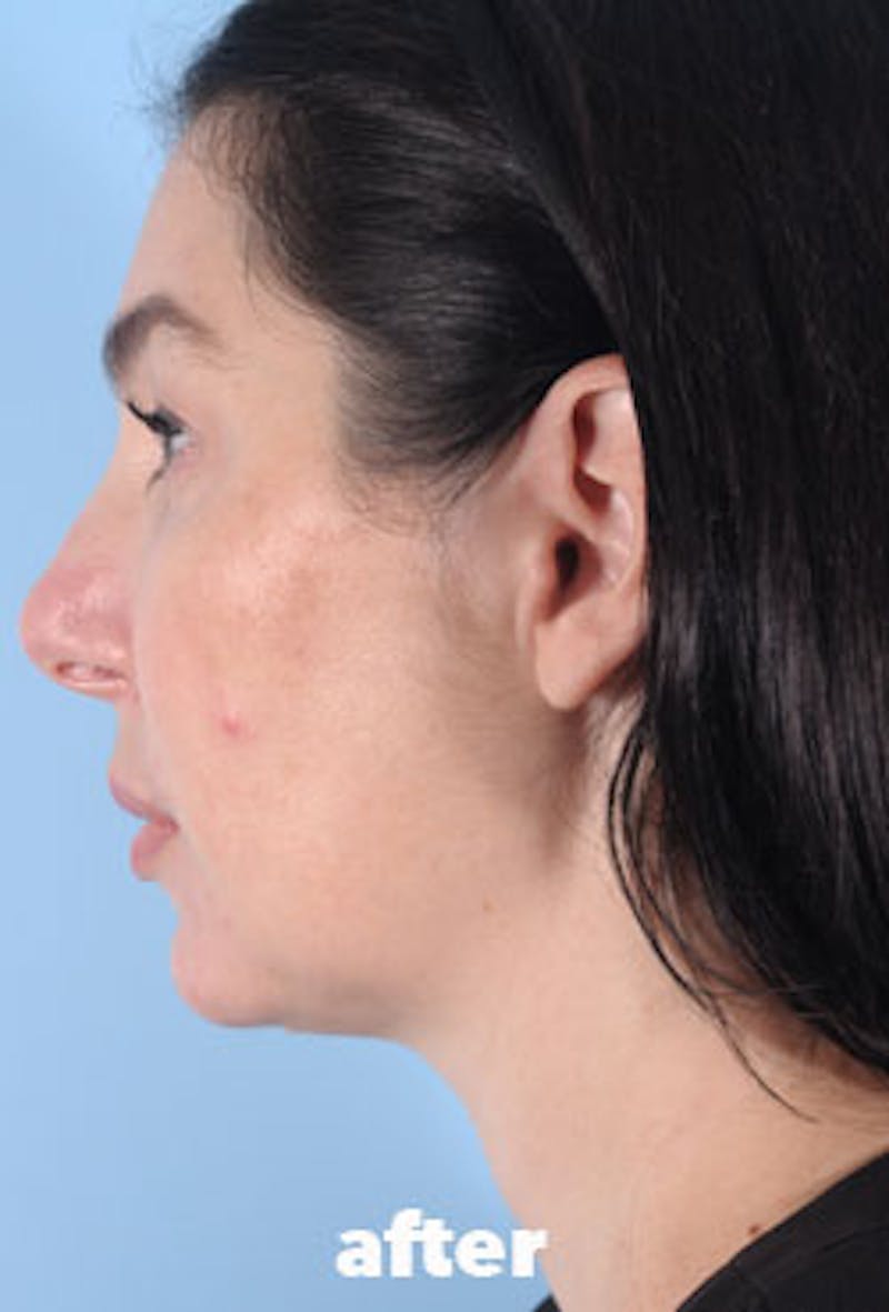 Coolsculpting Before & After Gallery - Patient 208005 - Image 8