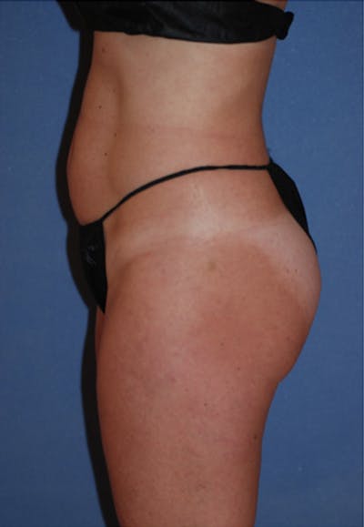 Ultrashape Before & After Gallery - Patient 295989 - Image 1