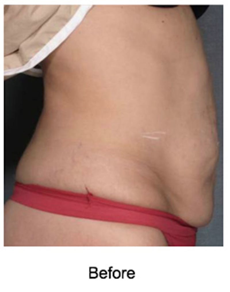VelaShape Before & After Gallery - Patient 358259 - Image 3