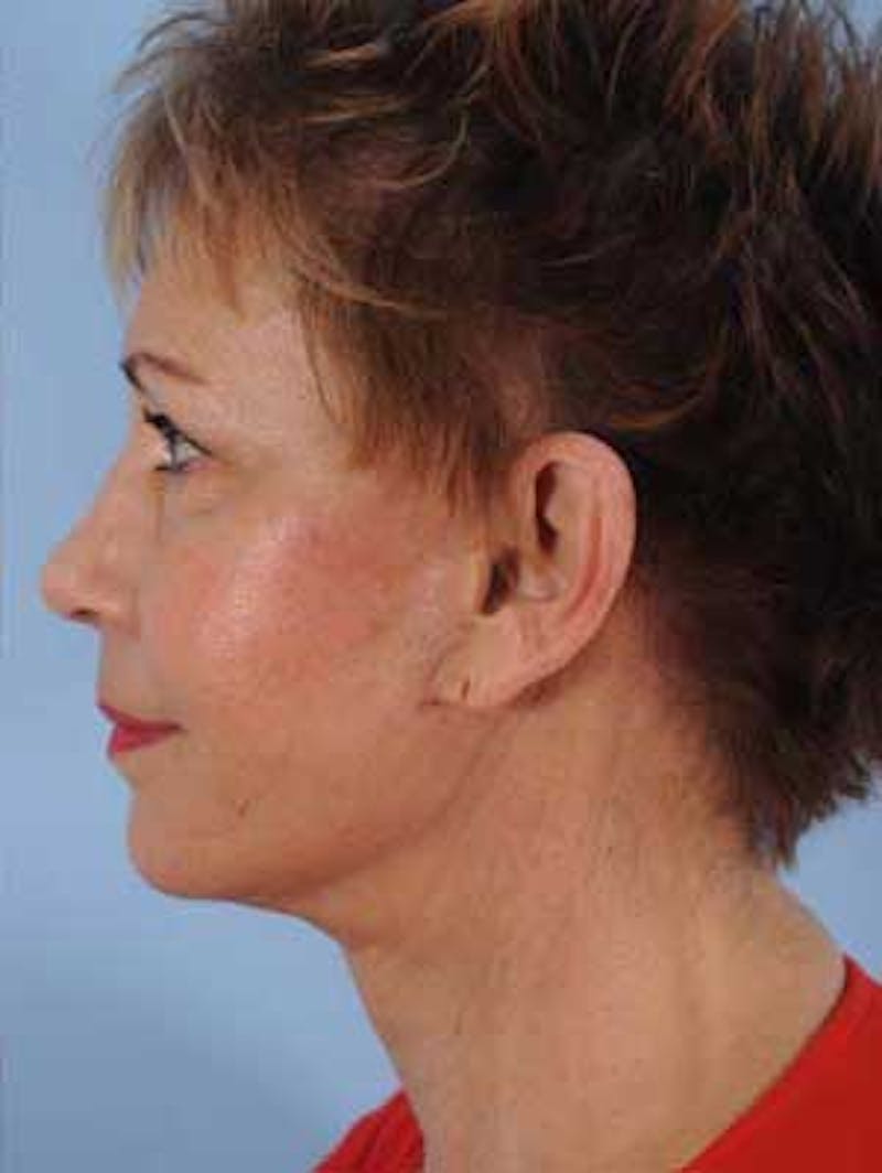 Facial Resurfacing Before & After Gallery - Patient 313472 - Image 4