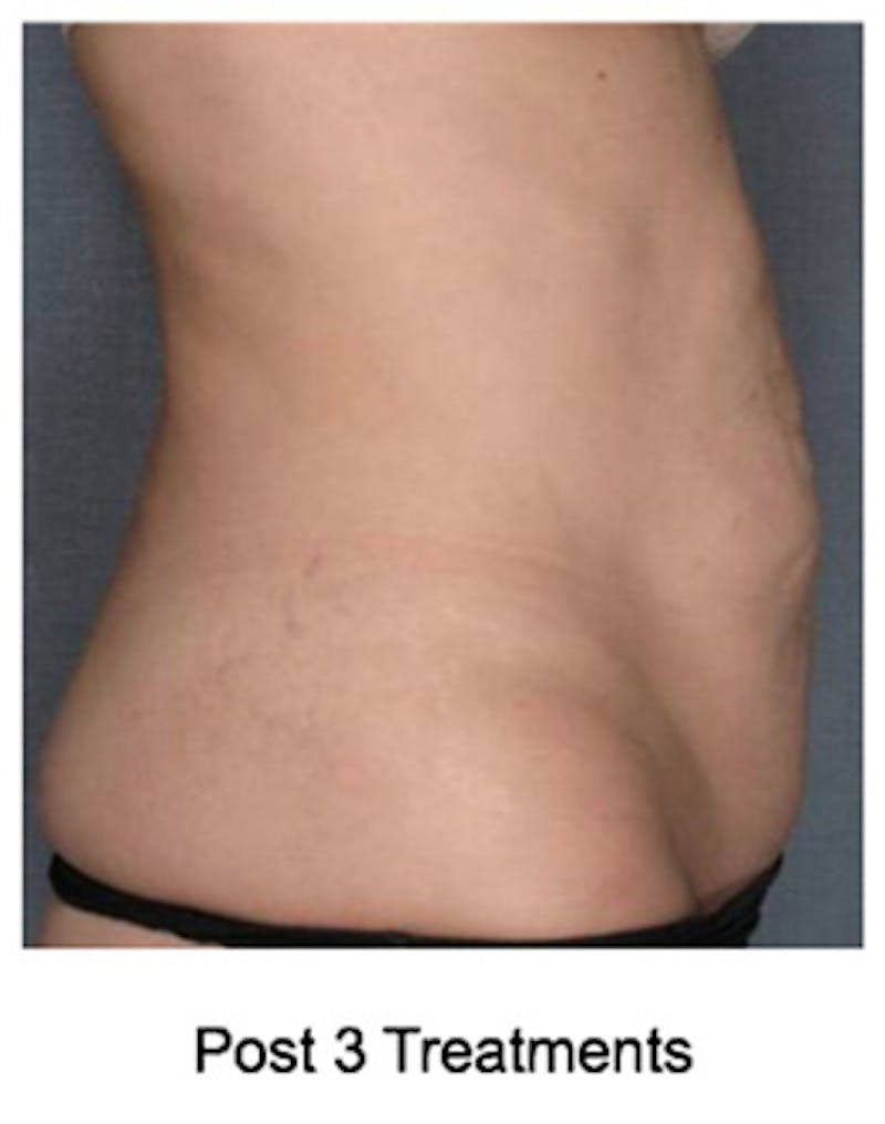 VelaShape Before & After Gallery - Patient 358259 - Image 4