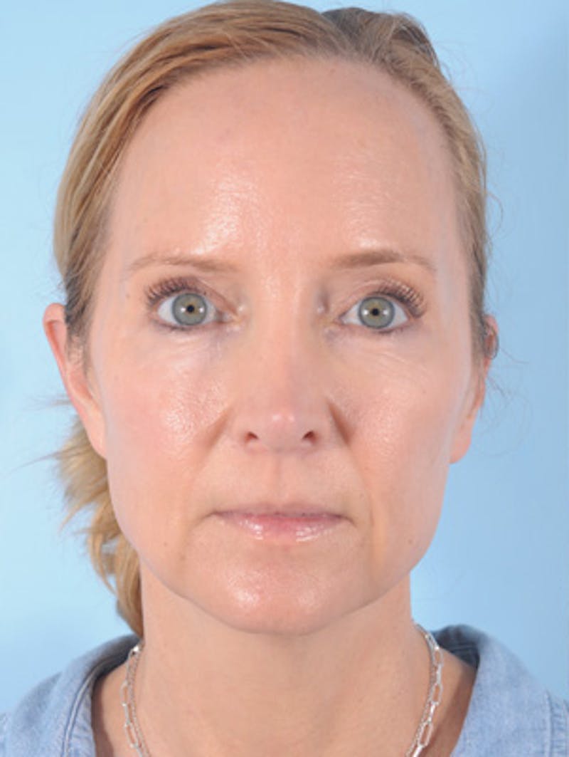 Facelift Before & After Gallery - Patient 472008 - Image 1