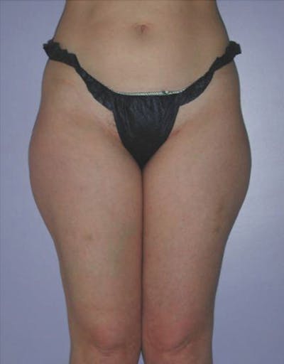 Ultrashape Before & After Gallery - Patient 152278 - Image 1