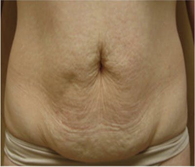 VelaShape Before & After Gallery - Patient 123388 - Image 1