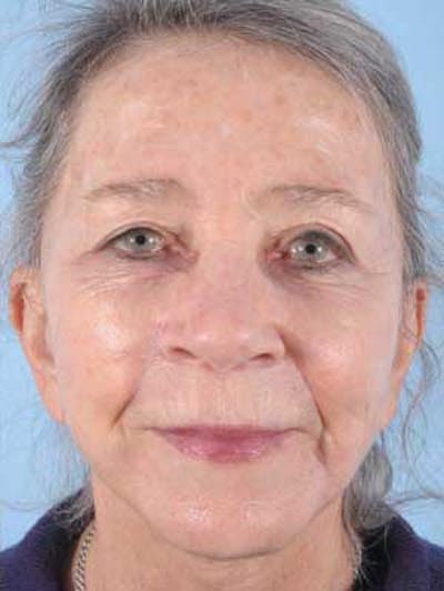Facial Resurfacing Before & After Gallery - Patient 118091 - Image 2