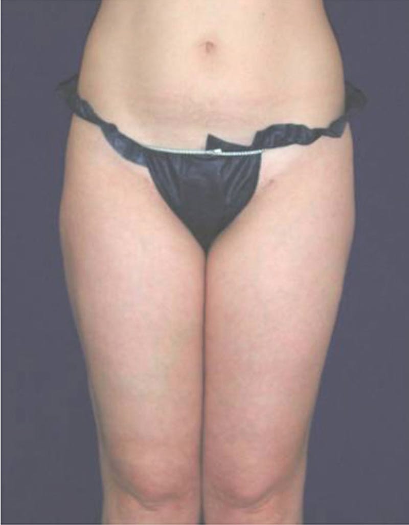 Ultrashape Before & After Gallery - Patient 152278 - Image 2